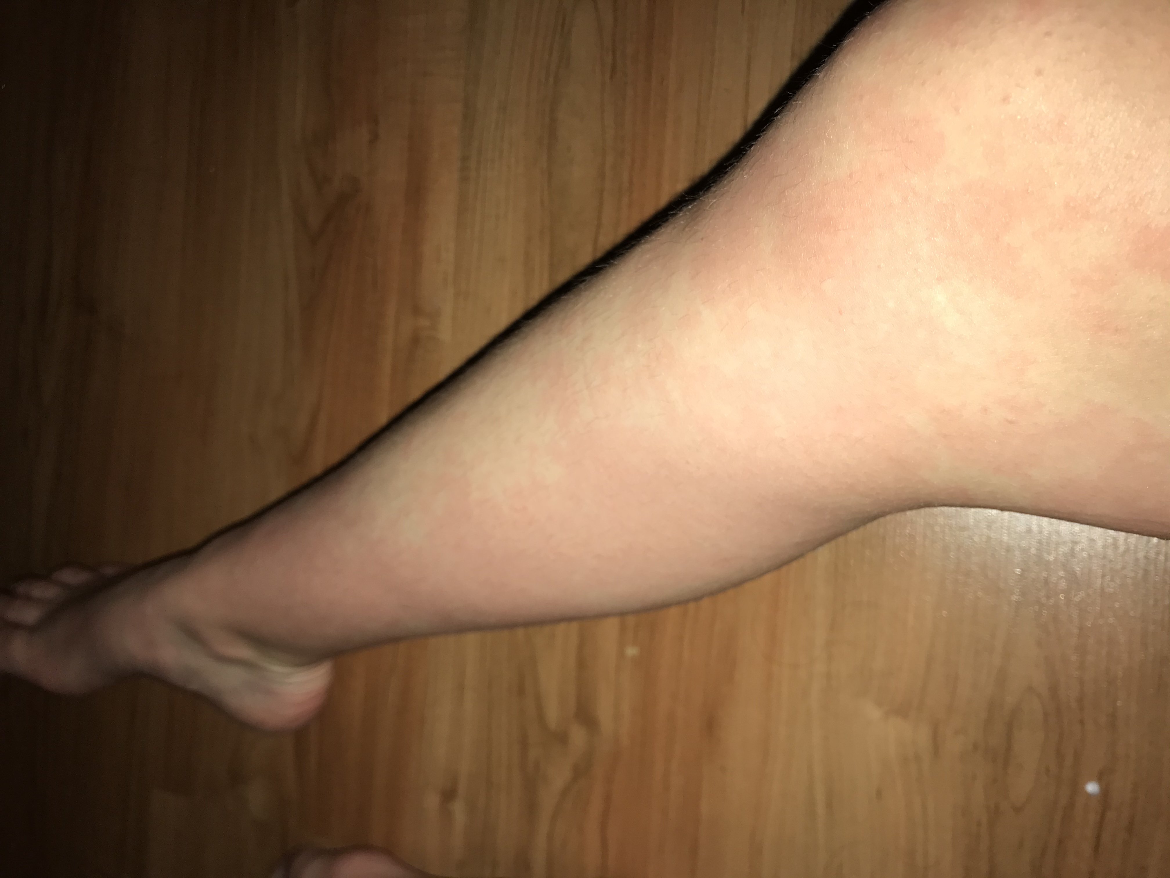 doden vertrekken Wijzigingen van Ik heb sinds ongeveer een jaar gekke, rode vlekken op mijn benen. Wat is  dit en wat kan ik eraan doen? - GoeieVraag