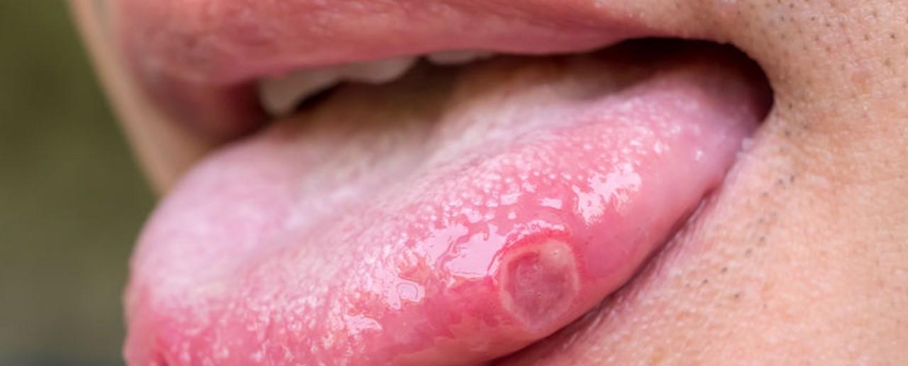 Blaasjes op de tong de oorzaken en adviezen Startpagina Blog