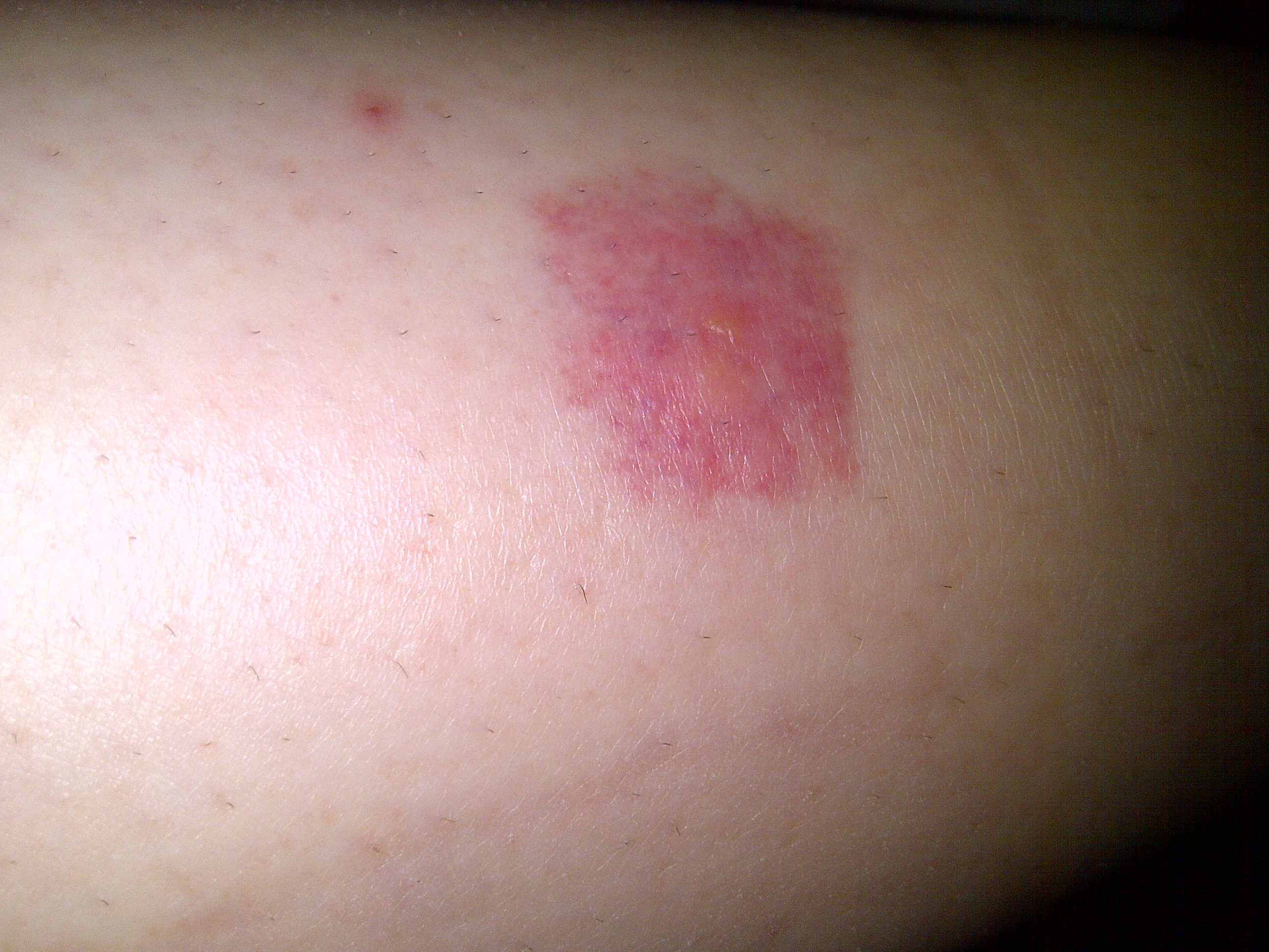 Kleren Suradam regen Wat kan dit zijn: Een grote rode kring op mijn arm waar eerst een muggebult  zat? - GoeieVraag